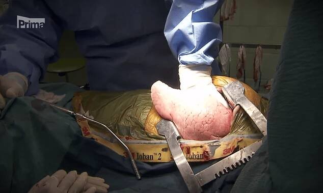 Transplantace plic v dalším díle Nemocnice Motol | topvip.cz