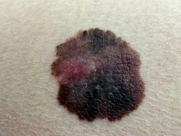 rakovina kůže. melanom - melanom - stock snímky, obrázky a fotky