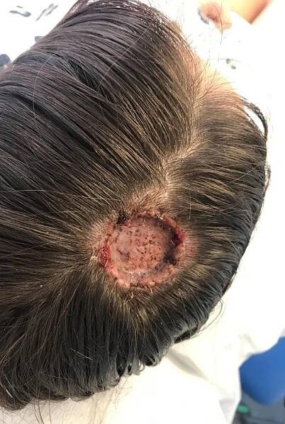 Ženě (36) závislé na solárku se na hlavě objevila bulka: Po operaci po ní zůstala obří díra!