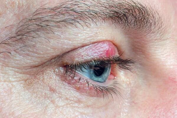 chalazion na víčku muže zblízka - chalazion - stock snímky, obrázky a fotky