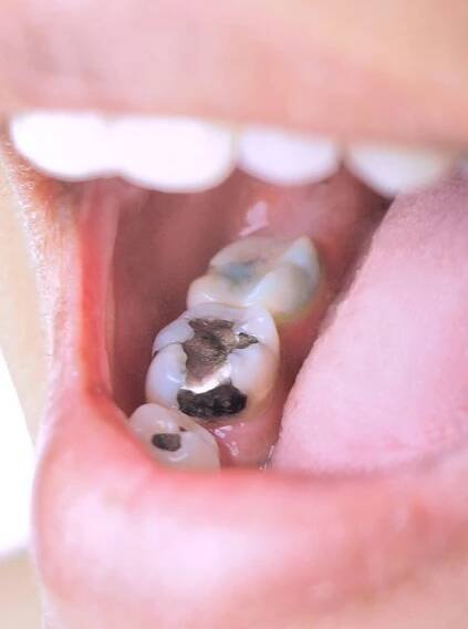 SMART Amalgam Removal in Bellflower | Cedar Smiles Dentistry