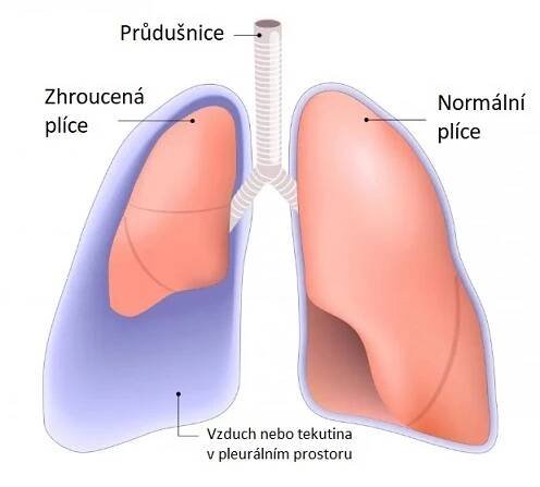 Propíchnutá plíce (pneumotorax, zhroucená plíce) – příznaky, příčiny a léčba