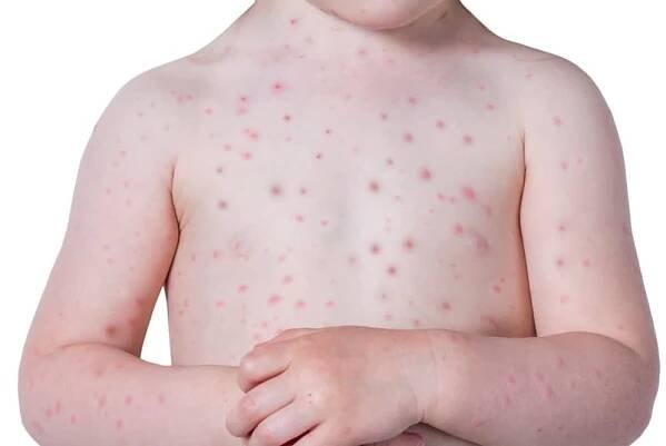 Nemoci doprovázené vyrážkou. Rozpoznáte neštovice od smrtelné meningitidy?