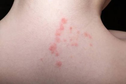 Kožní vyrážka a alergie s červenou skvrnou příčina — Stock obrázek