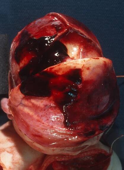 Fetal Autopsy: Brain | The Autopsy Book