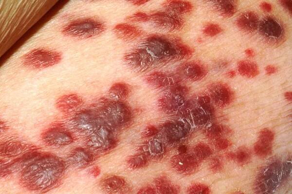 Sarcoma