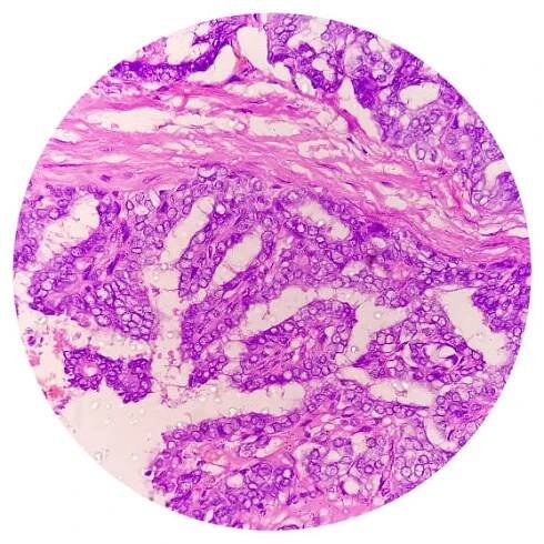 metastazující papilární karcinom štítné žlázy (rakovina), centrální lymfatická uzlina. - axillary lymph node - stock snímky, obrázky a fotky