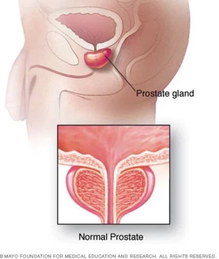 Prostatitis — A Complete Guide