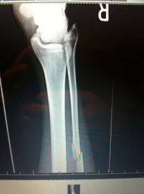 Zlomenina lýtkové kosti: Příznaky, léčba a další