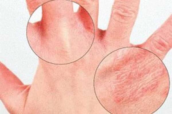 Příčiny, příznaky a léčba psoriatické artritidy / Artritida | Užitečné informace a tipy na péči o sebe. Zdraví, výživa a