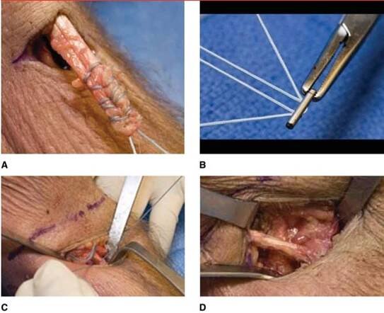Distal Biceps Avulsion - Shoulder & Elbow - Orthobullets 