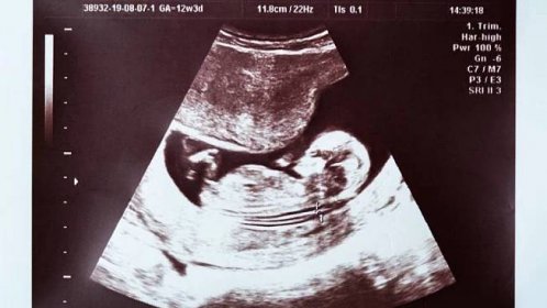 Přibližně takto vypadá ultrazvuk kolem 20. týdne těhotenství.