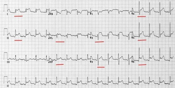 Perikarditida - EKG | Medicína, nemoci, studium na 1. LF UK