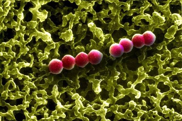 Pneumococcus (Streptococcus pneumoniae) bacteria. Pneumococcus is the bacterium that causes pneumonia, bronchial pneumonia, purulent pleurisy, bacterial meningitis, ear infections, sinusitis and conjunctivitis.