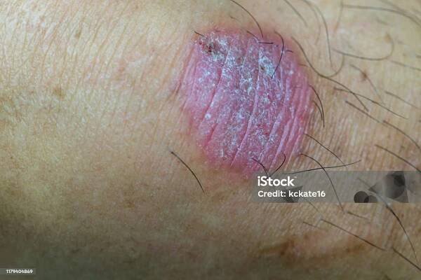 Infekce kruhového červa, dermatofytóza na kůži. Kožní infekce nebo Tinea na kůži. Infekce mykózy na lidské kůži. Je způsobena houbou - Bez autorských poplatků Celulitis - Zánět Stock fotka