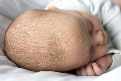 seboroická dermatitida kůry na hlavě dítěte. dítě se seborrhea ve vlasech - seboroická dermatitida - stock snímky, obrázky a fotky