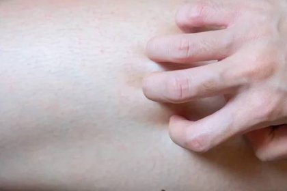 U mladých žen se objeví vyrážka na nohou Alergické příznaky Používá ruce k poškrábání vyrážky. — Stock obrázek