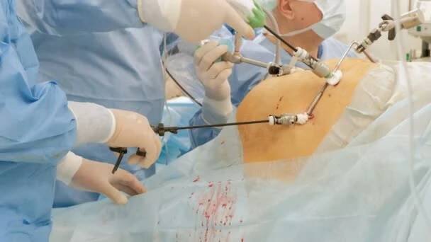 2019-01-25 Kostanay, Kazachstán. Laparoskopie v nemocnici. Tým profesionálních lékařů na břicho pacienta provést endoskopii. Closeup břišní chirurgie tuku nebo těhotná žena. — Stock záběr