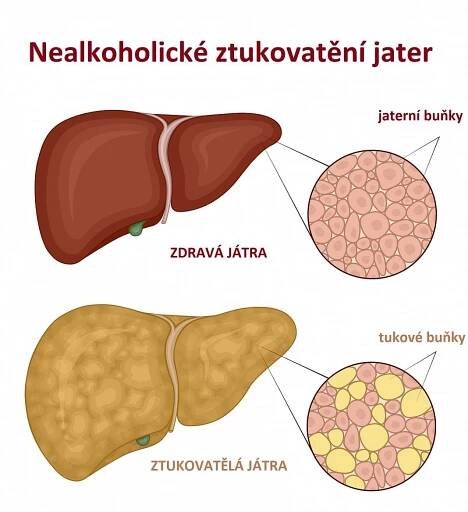 Cirhóza jater se může skrytě vyvíjet řadu let. V pozdním stadiu pomůže jedině transplantace