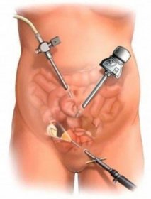 Odstranění ovariální cysty - laparoskopická operace