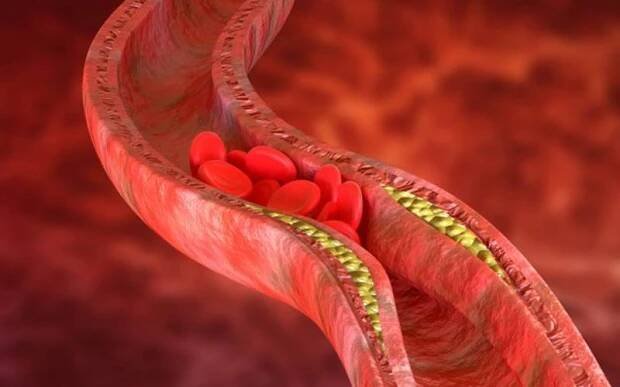 Cholesterolem zanešené cévy dříve či později způsobí infarkt nebo mrtvici. Naučte se proto cévy udržovat v kondici - AAzdraví.cz