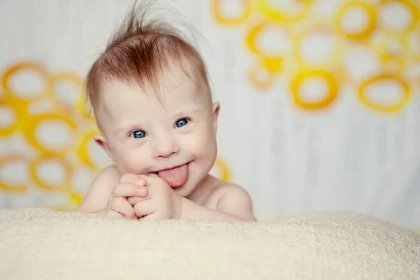 Veselá malá holčička s downs syndrom — Stock fotografie