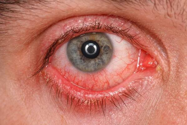 Pink Eye (Conjunctivitis)