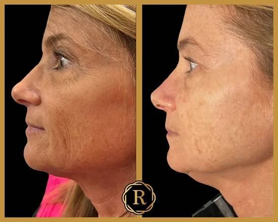 Morpheous8 before and after