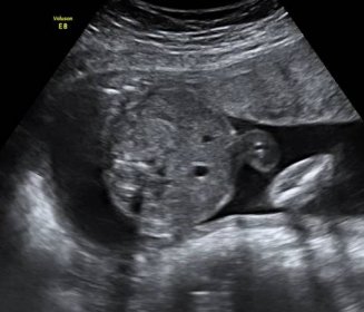 Fotky z ultrazvuku ve 20. týdnu těhotenství
