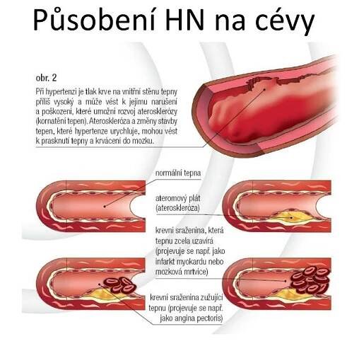 PPT - Hypertenze PowerPoint Presentation, free download - ID:5957312