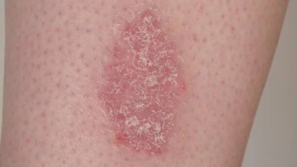 Zavřít, makro: bolestná rána se úspěšně uzdravila poté, co spadl z rány. Psoriasis pacient přichází do ordinace, aby prozkoumal peskytu vyrážku na noze. Kavkazský člověk s genetickou kožní podmínkou. — Stock záběr