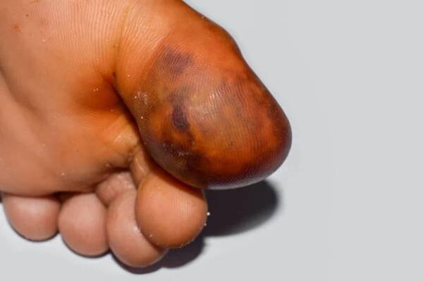 absces a celulitida nebo stafylokoková, streptokoková kožní infekce u palce asijského mužského pacienta. - celulitis zánět - stock snímky, obrázky a fotky