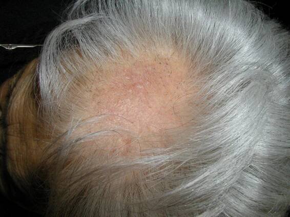 Perdita dei capelli