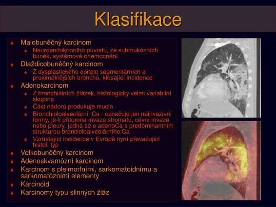 PPT - Nádory plic, pleury a mediastina: BRONCHOGENNÍ KARCINOM PowerPoint Presentation - ID:5892677