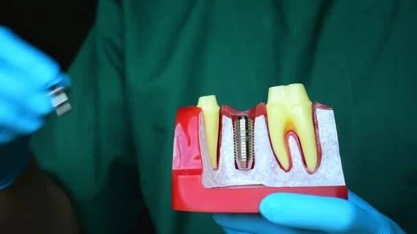 Detailní fotografie implantátu zubního lékařství je náhrada za chybějící zuby rukou zubaře. — Stock záběr