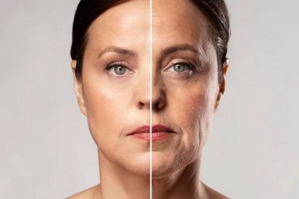 Woman showing effects of botox treatment on the face.