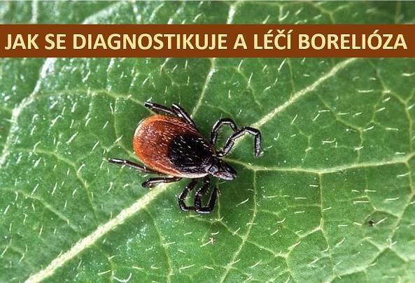 Diagnostika a léčba boreliózy