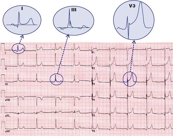 ECG benign early repolarisation, concave ST elevation, fish hook pattern, ST T ratio, J wave notch