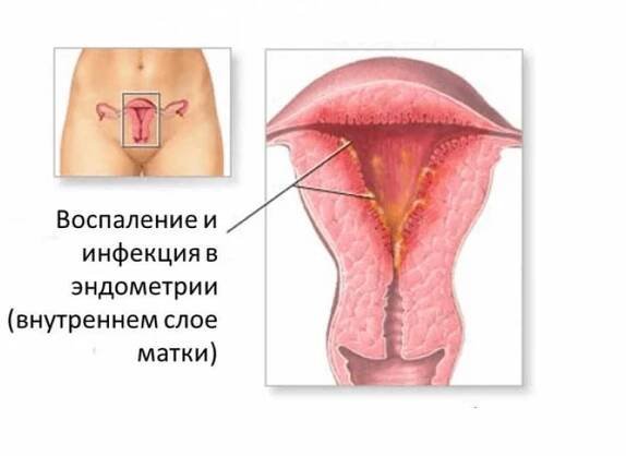 Akutní endometritické příčiny a účinné metody léčby / Články