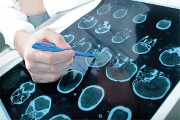 Příčiny, příznaky, stadia, léčba Parkinsonovy nemoci? / Parkinsonova choroba | Užitečné informace a tipy na péči o sebe